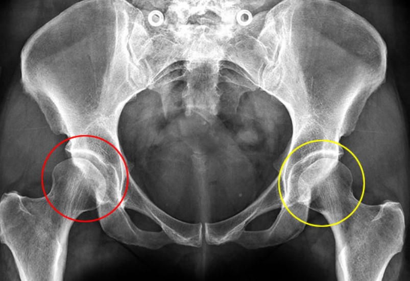 Hip dysplasia